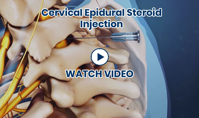neck epidural steroid injection