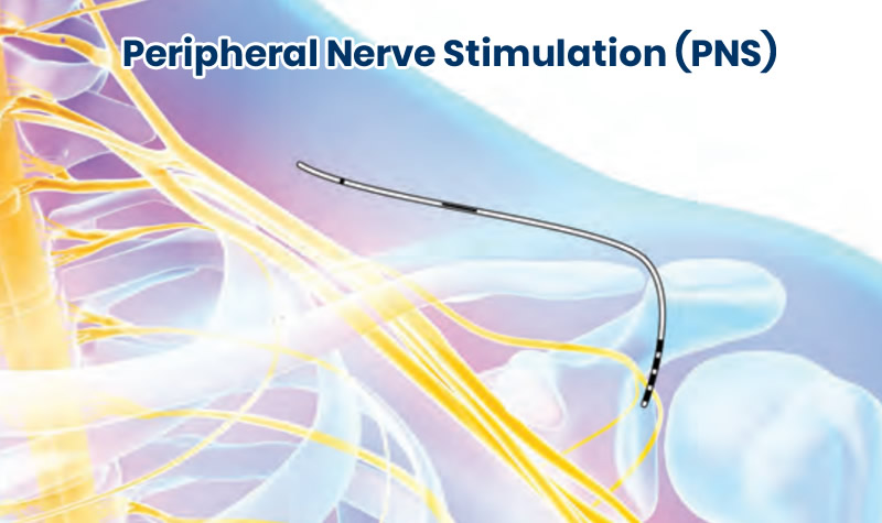 peripheral nerve stimulator